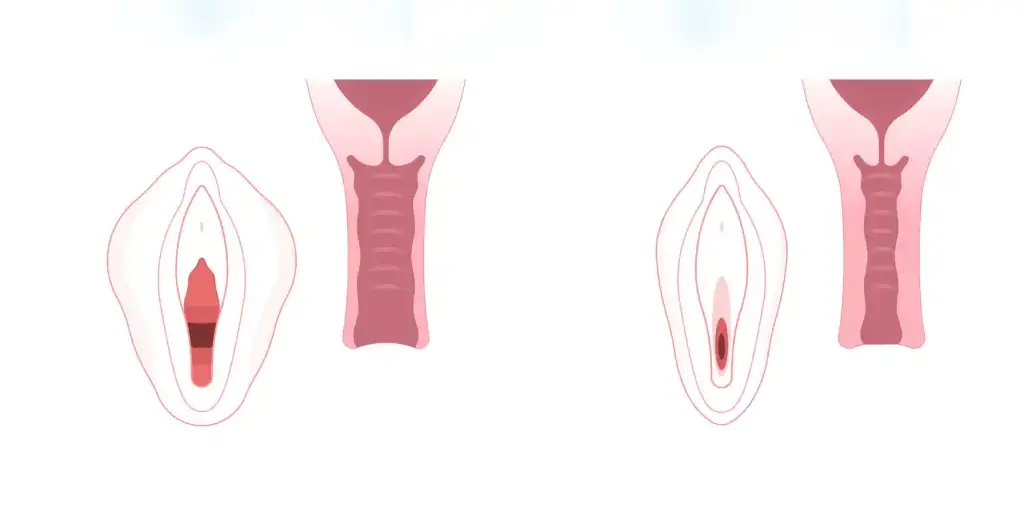 راه‌های تنگ کردن واژن