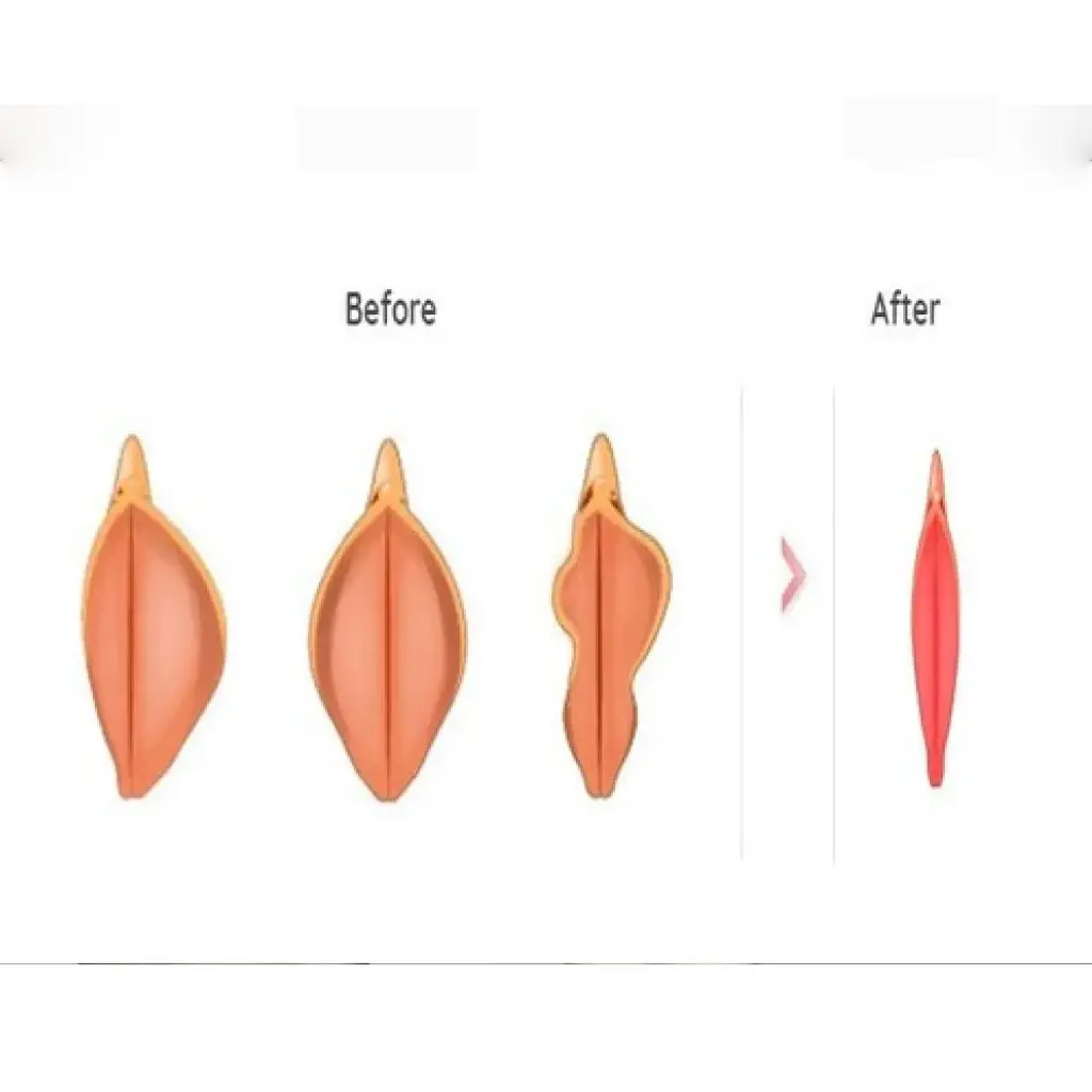 تأثیر مثبت لابیاپلاستی بر کیفیت زندگی و سلامت واژن