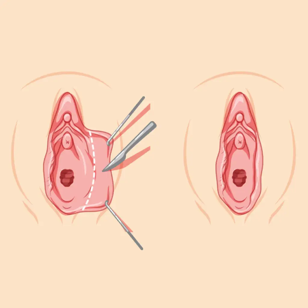 نکاتی درباره ظاهر پس از لابیاپلاستی