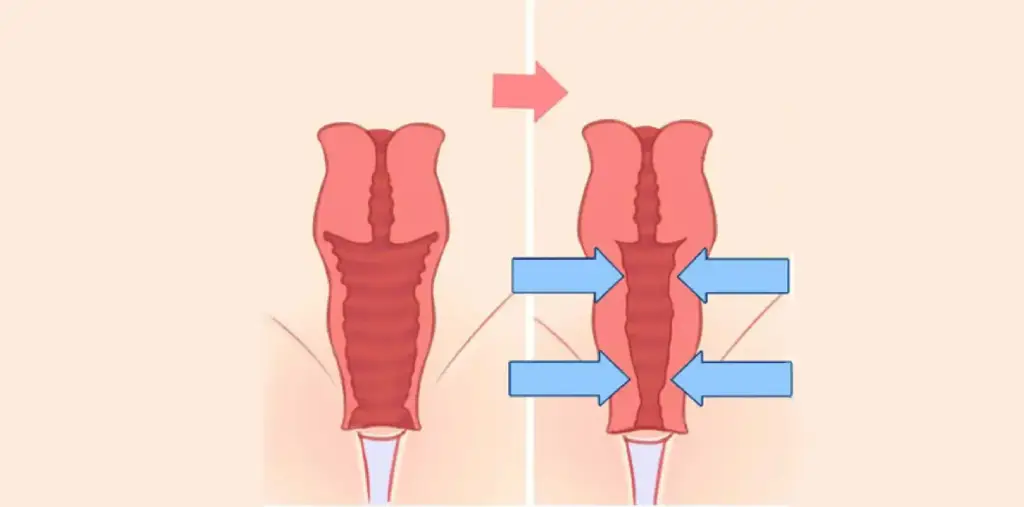 واژینوپلاستی یا تنگ کردن واژن
